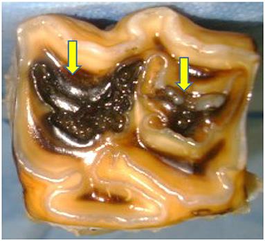 A Computed Tomographic (CT) and Pathological Study of Equine Cheek Teeth Infundibulae Extracted From Asymptomatic Horses. Part 1: Prevalence, Type and Location of Infundibular Lesions on CT Imaging